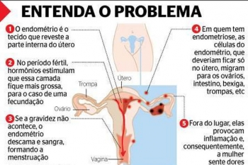 Afinal, o que é a endometriose?