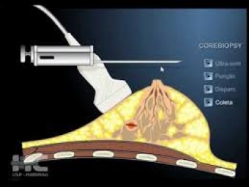 CORE BIOPSY DE MAMA